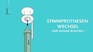 Stimmprothesenwechsel mit einem Inserter  Animation  Fahl MedizintechnikVertrieb GmbH [upl. by Akitahs]