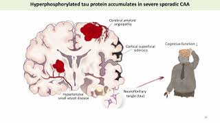 Cerebral Tau Pathology in Cerebral Amyloid Angiopathy [upl. by Ahsinek]