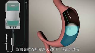 Elipse Intragastric Balloon [upl. by Shultz]