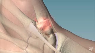 Mayo Clinic Minute Cause remedies for thumb arthritis [upl. by Germayne479]