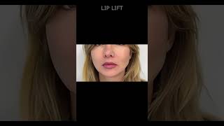 Efekt po zabiegu LIP LIFT [upl. by Nadean]