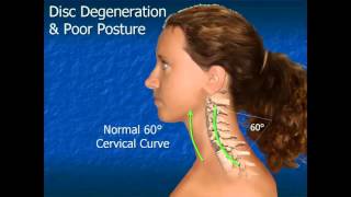 Cervical Disc Degeneration  Degenerative Disc Disease [upl. by Thorne]