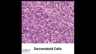 Sarcomatoid Mesothelioma Asbestos Mesothelioma Attorney 7 [upl. by Tnahsin]