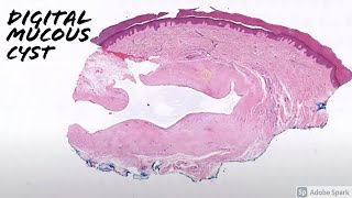 Digital Mucous Cyst vs Ganglion Cyst 5Minute Pathology Pearls [upl. by Hyacintha]