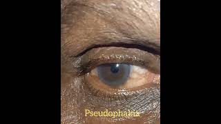 Mature cataract  Pseudophakia  senile mature cataract  pseudophakia vs cataract [upl. by Atrice]