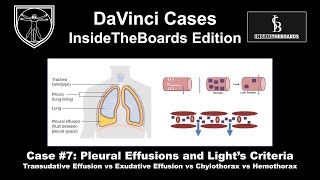 Pleural Effusions and Lights Criteria DaVinci Cases  InsideTheBoards Edition Case 7 [upl. by Macpherson]