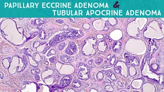 Papillary Eccrine AdenomaTubular Apocrine Adenoma Dermpath in 5 Minutes [upl. by Trudie]