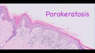 Porokeratosis [upl. by Ozner]