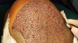 Hair Transplant in Bangladesh By Prof Dr Bakhtiyar Kamal [upl. by Raynata933]