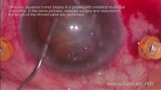 Vitreous aqueous humor biopsy in a patient with unilateral multifocal choroiditis In the same pro [upl. by Yerag]