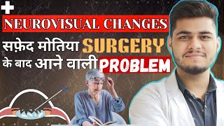 Neurovisual changes after cataract Surgery  Cataract surgery [upl. by Varney]