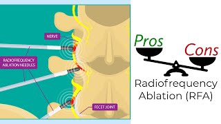 Radiofrequency Ablation  Pros amp Cons [upl. by Tiffani432]