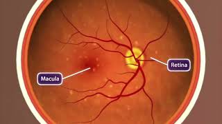 AgeRelated Macular Degeneration AMD [upl. by Jeramie]