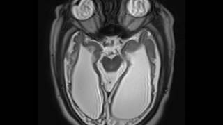 Periventricular Leukomalacia [upl. by Niawat]