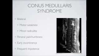 Review of Conus Medullaris Syndrome vs Cauda Equina Syndrome [upl. by Namwen526]