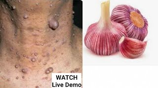 Get Rid Of Skin Tags  Use Garlic To Remove Skin Tags In Just 3 Days [upl. by Rockwell]