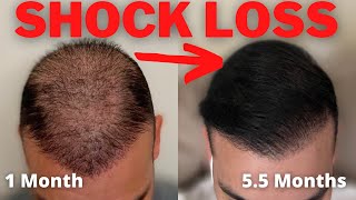 Shock Loss After A Hair Transplant Everything You Need To Know [upl. by Quirk]