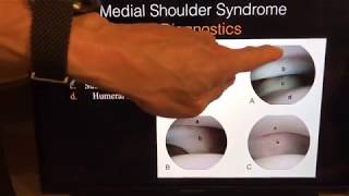 Canine Medial Shoulder Syndrome With Drs Canapp and Susan Garrett [upl. by Ardnasirk]