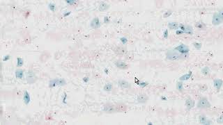 Cervix Low Grade Squamous Intraepithelial Lesion LSIL AutoCyte Histopathology  Madeformedicalcom [upl. by Hguh847]