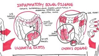 Inflammatory Bowel Disease  Crohns and Ulcerative Colitits [upl. by Lertnom]