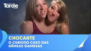 O misterioso caso das gêmeas siamesas dicéfalas [upl. by Cianca225]