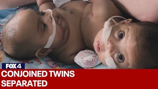 FULL VIDEO Conjoined twins separated at Cook Childrens Medical Center [upl. by Mozes]