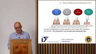 Prof Dr Stefan Ihde on Periimplantitis  International Implant Foundation [upl. by Suhcnip]