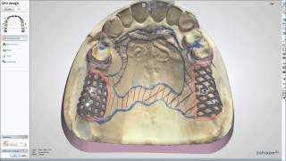 Dental System™ 2013  Removable Partial Design [upl. by Aerdnahc]