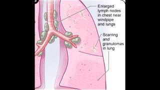 Sarcoidosis Noncaseating Granulomas [upl. by Maloy]