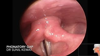 Phonatory Gap  Video Laryngoscopy [upl. by Valley863]