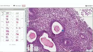 Endometrial Pathology for the Practicing Pathologist by Marisa Rose Nucci MD [upl. by Sairahcaz]