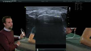 Elleboog  Common extensor tendon dwars  E14  echografie [upl. by Ezarras457]