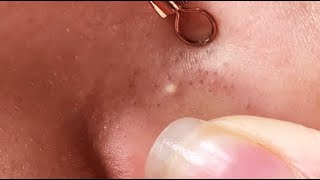 HOW YOU CAN REMOVE BLACKHEADS FROM NOSE AT HOME  RELAXING VIDEO WITH ELA [upl. by Neela]