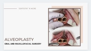 ALVEOLOPLASTY  DEANS ALVEOLOPLASTY  OBWEGESERS ALVEOLOPLASTY  ALVEOLECTOMY [upl. by Eema]