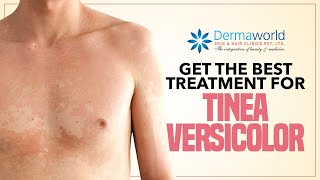 Get The Best Treatment for Tinea Versicolor [upl. by Bonny]