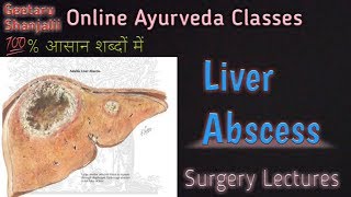 Liver abscess by Geetaru [upl. by Kurland]