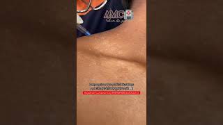 Vitiligo Skin Medical Point  Army Medical  SSCGD Medical  Virals video [upl. by Isewk204]