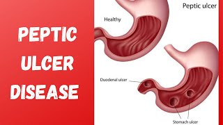 Peptic Ulcer Causes Risk factors Signs and Symptoms ManagementTreatment [upl. by Ileray]