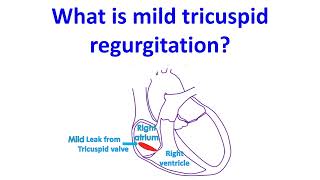 What is mild tricuspid regurgitation [upl. by Kassia]