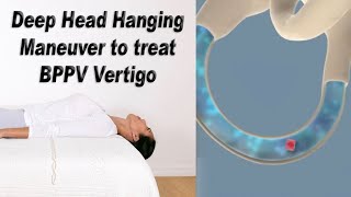 Deep Head Hanging Maneuver to Treat BPPV Vertigo [upl. by Formica]