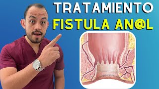 🔴 𝗙𝗜𝗦𝗧𝗨𝗟𝗔 𝗔𝗡𝗔𝗟 Síntomas Causas y Tratamiento [upl. by Zed]