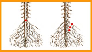 Cauda Equina vs Conus Medullaris Syndrome [upl. by Aicekal267]