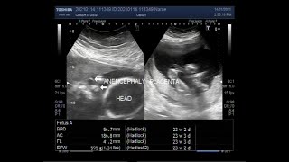 Twins with One Fetal Anencephaly [upl. by Analli]