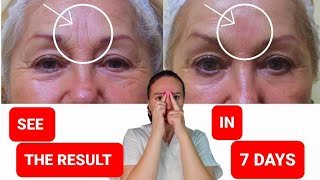 Get rid of FROWN LINES  Reduce FOREHEAD WRINKLES [upl. by Yrtua149]