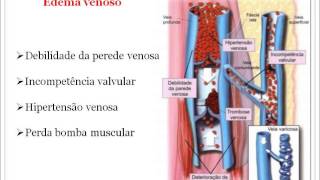 Semiologia do Edema [upl. by Salisbury927]