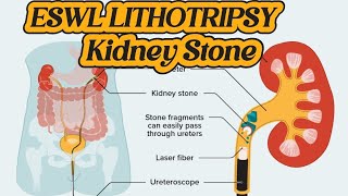 Operation of Lithotripsy  ESWL Lithotripsy  Kidney Stone Treatment  Renal DJ Stent [upl. by Ahseram60]