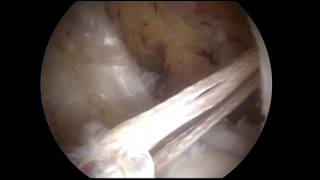 ACL Reconstruction with Single Bundle Hamstring Graft Graftlink [upl. by Oguh371]