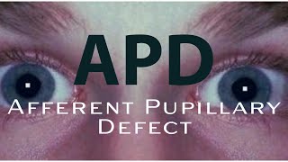 How to detect an APD Afferent Pupillary Defect [upl. by Ita]