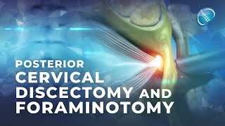 What is Endoscopic Posterior Cervical Discectomy and Foraminotomy [upl. by Mallissa]