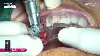 Online Surgery 13 immediate implant placement KSⅢ with dual zone graft [upl. by Lazarus]